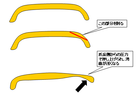 素人でもできる陥入爪 爪周囲炎 の治療